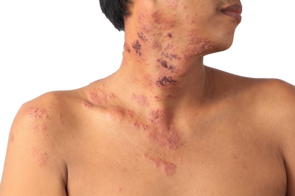 Er helvetesild smittsomt?